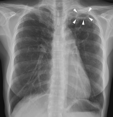 Lungtuberkulos på en röntgenbild